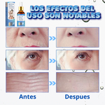 Botox Stock Solution -  Suero Antiarrugas
