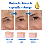 Botox Stock Solution -  Suero Antiarrugas
